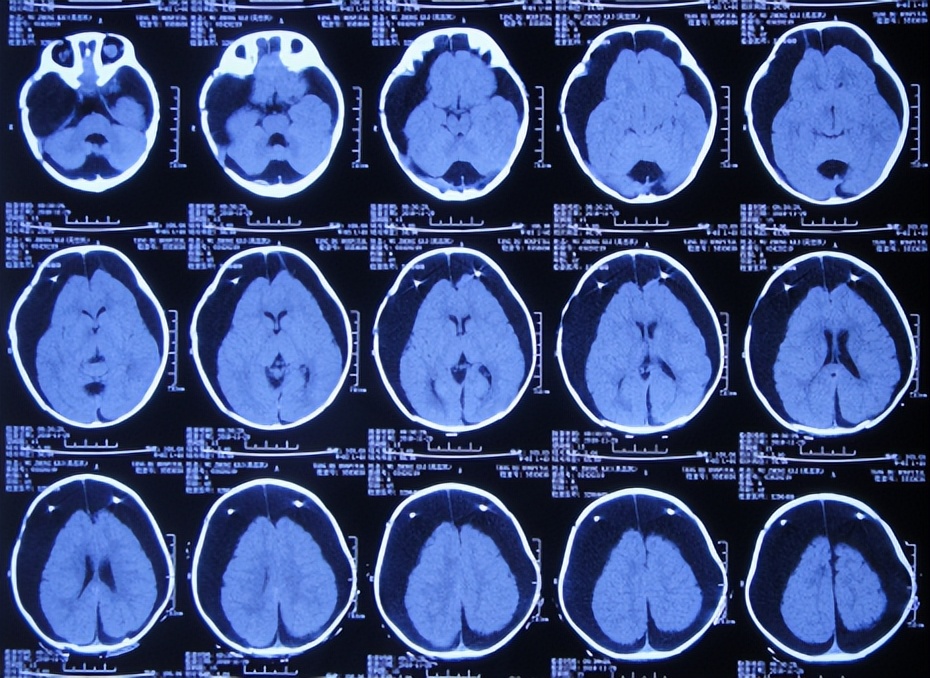 蛛网膜囊肿合并脑积水腹腔分流术,治疗蛛网膜囊肿引起脑积水严重吗