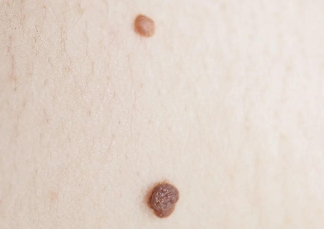 痣的旁边长了几个小痣是癌变吗,痣的变化和身体健康的关系