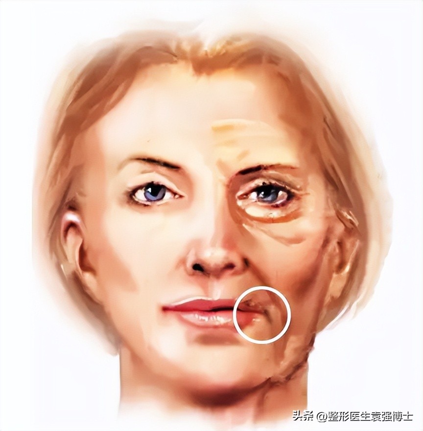 口角囊袋下垂怎么办,口角囊袋去掉会不会变松弛
