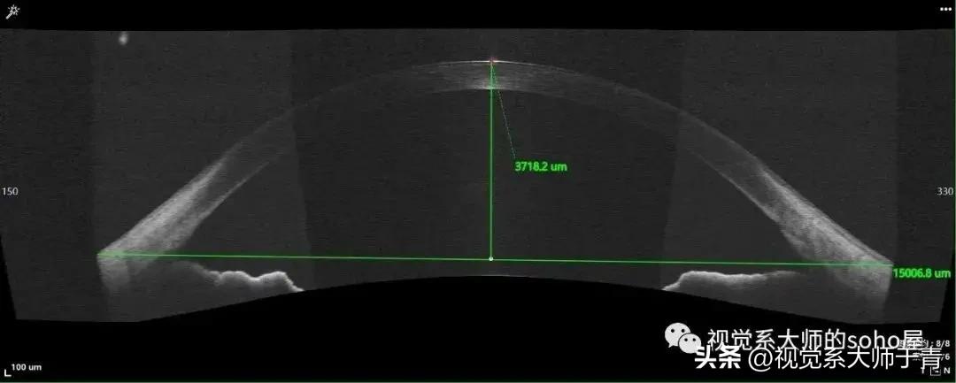 巩膜镜的验配技巧及案例分享,试戴巩膜镜成功率高不高