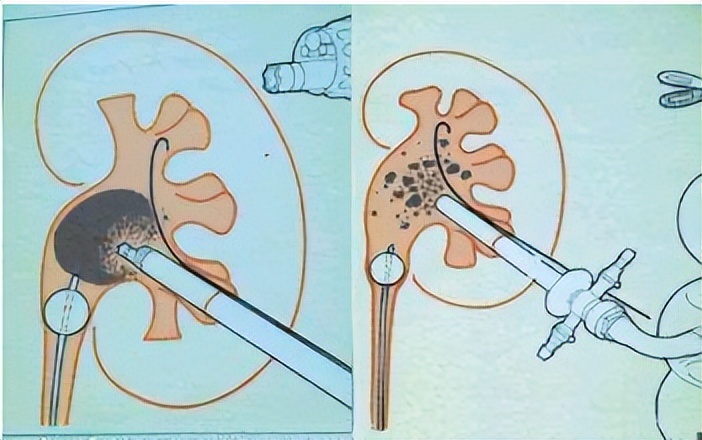 经皮肾镜取石术手术指征,经皮肾镜取石术并发症有哪些