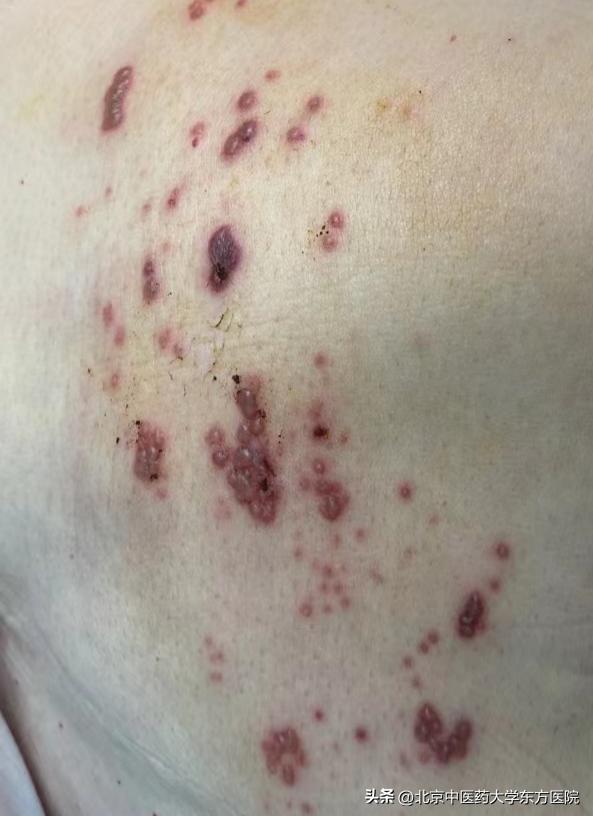 带状疱疹的疼痛和出疹有关联吗,带状疱疹神经痛会越来越痛吗