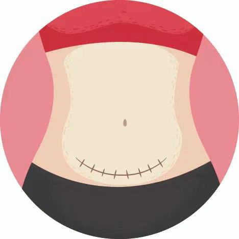 去除剖宫产疤痕增生最有效的方法,剖宫产疤痕憩室怎么去除