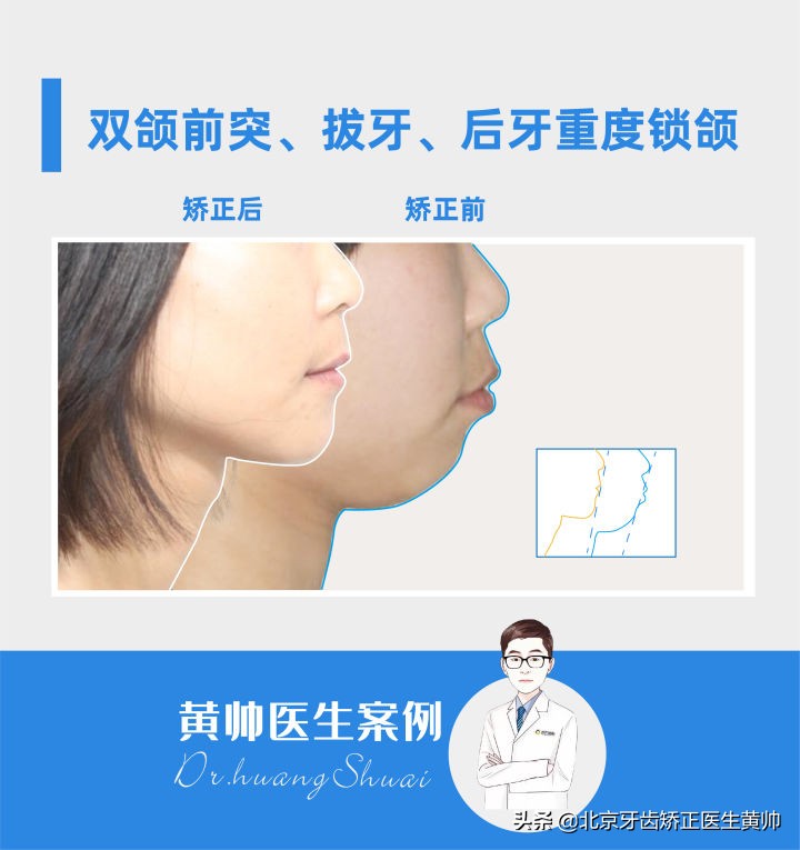 嘴凸的人怎么笑起来好看,嘴型比较凸的人怎么改善