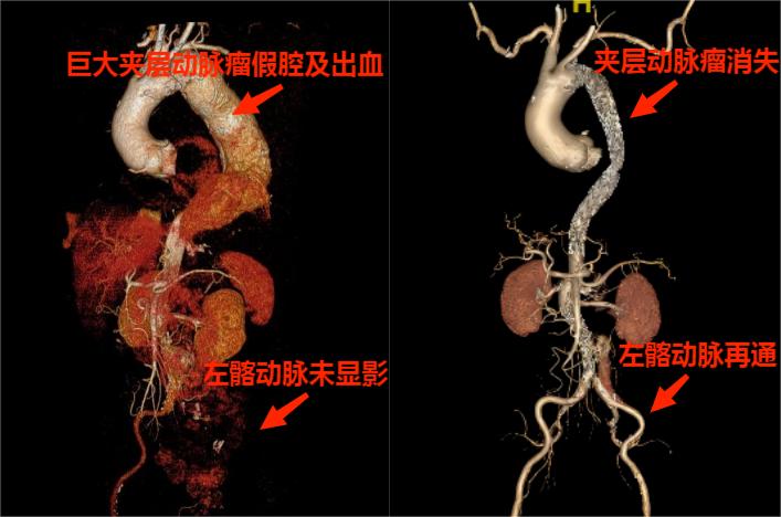 南昌大学二附院脑动脉瘤,南昌大学二附院血管介入科