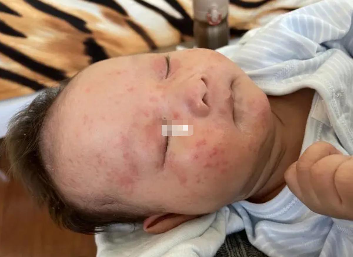 两个月宝宝脸上长小红痘痘痒,两个月宝宝用了面霜长痘痘了