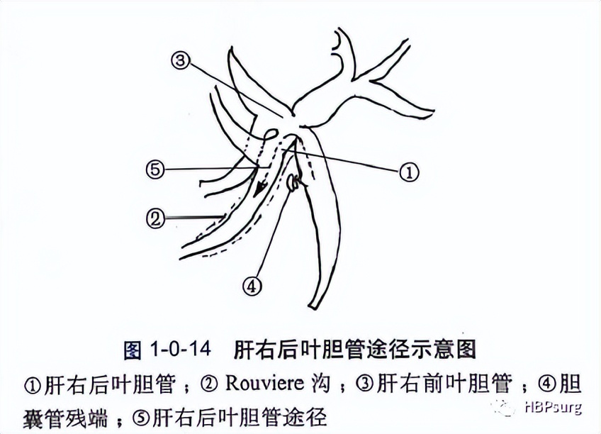 关于肝胆管结石治疗的入肝途径的总结
