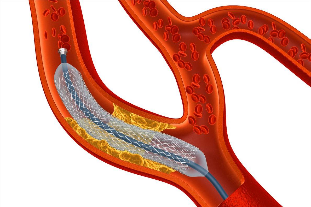 血管狭窄70%放支架还是搭桥好,心血管狭窄搭桥好还是支架好