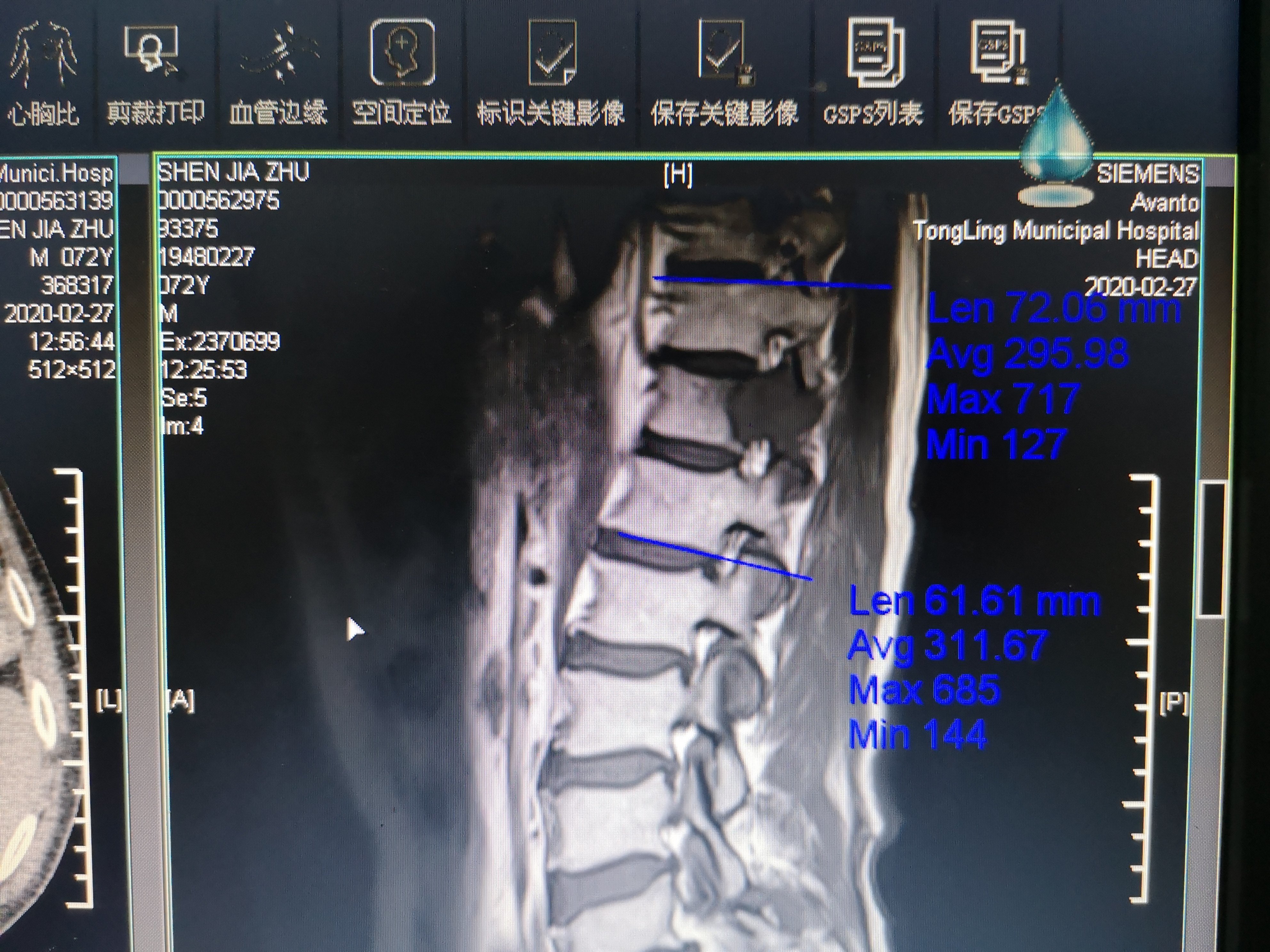 食管癌诊断金标准,食管癌诊疗规范2020电子版
