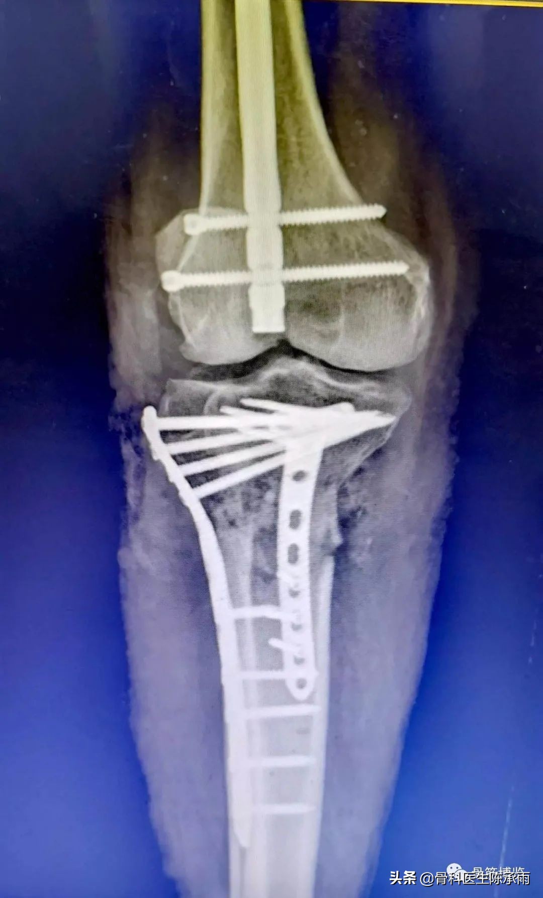 陈旧性腿骨骨折,陈旧性骨折