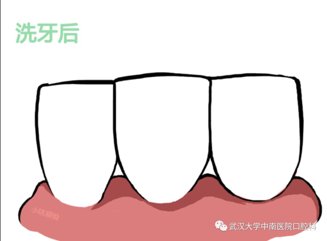 洗牙牙缝变大的原因和解决方法,牙缝特别小怎么洗牙