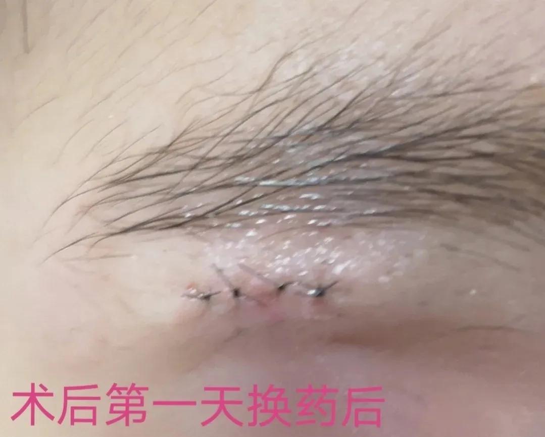 皮脂腺囊肿挤出囊袋,皮脂腺囊肿切除手术