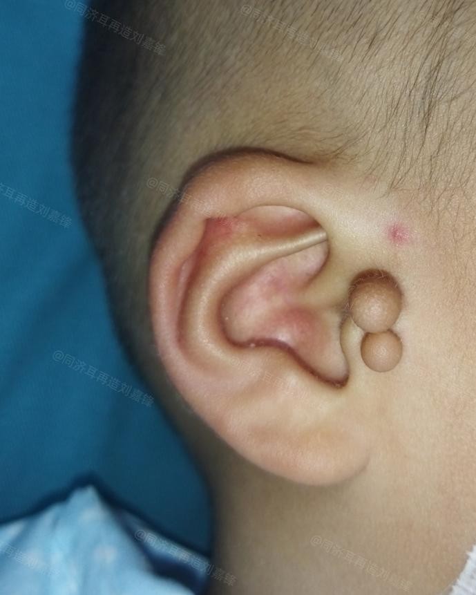 小孩耳朵长了个小肉球,儿童耳朵长了一个小肉球