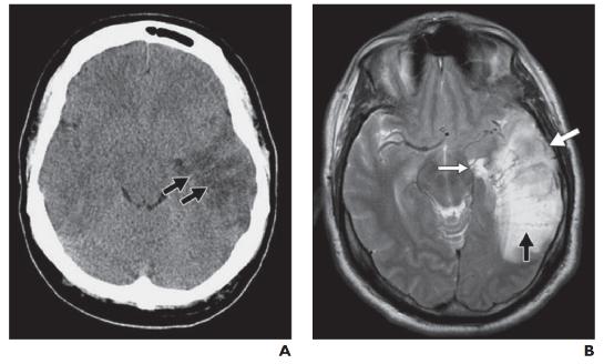 脑水肿的影像,脑水肿形成机制生理学