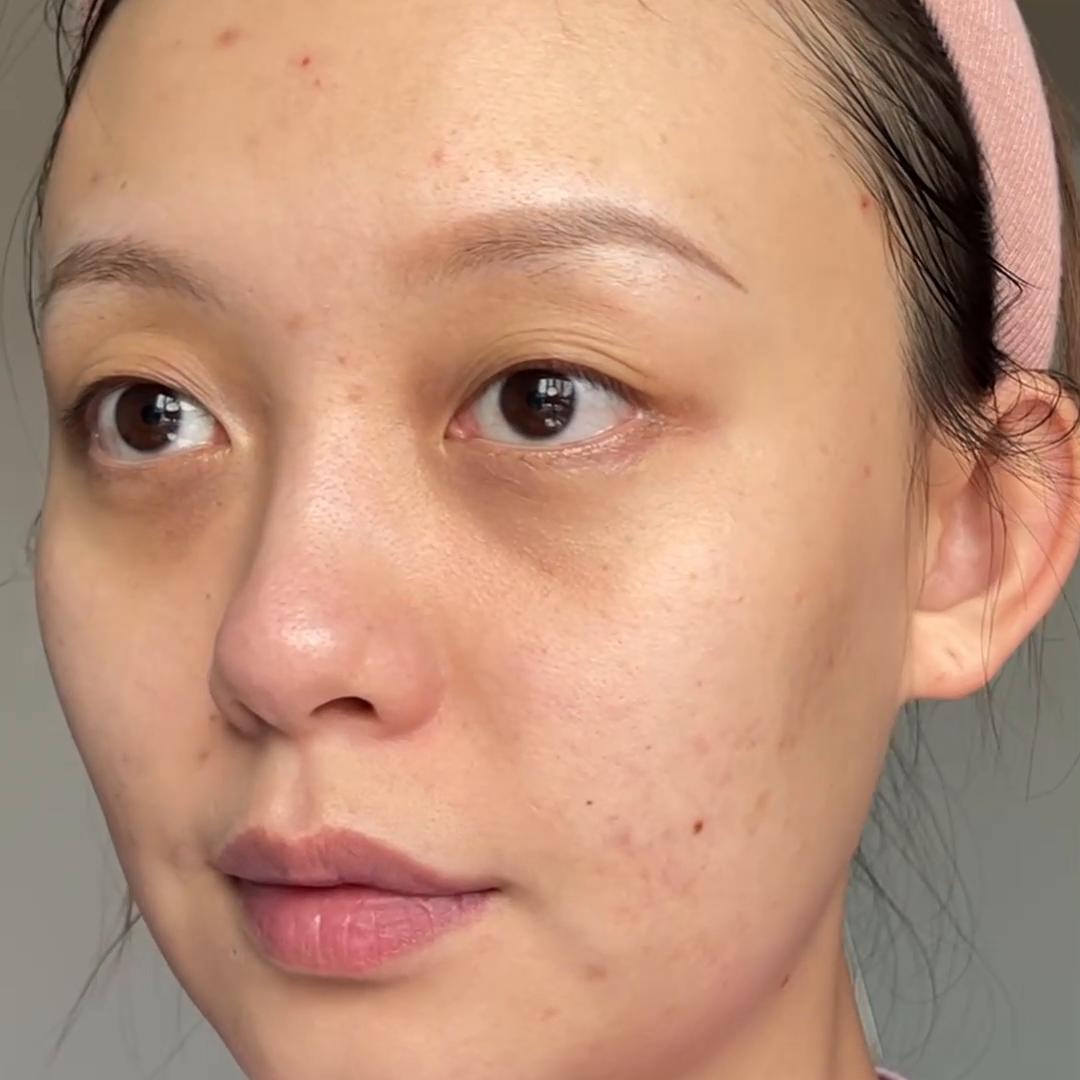 痘肌祛闭口的最好方法,闭口混合痘肌如何护肤