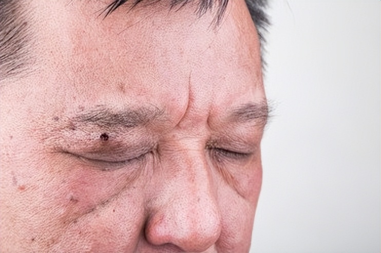 这8个部位长痣或是癌症前兆,痣长在身体这8个部位要小心癌症