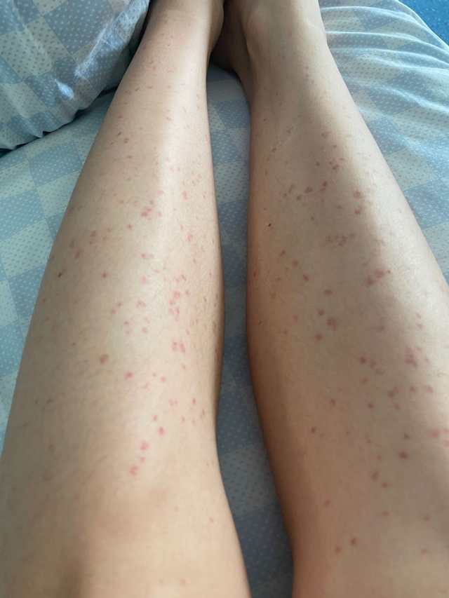 紫癜好了多久可以正常饮食,紫癜一直不消怎么回事