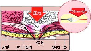 坐轮椅如何预防压疮,坐轮椅屁股压疮怎么办