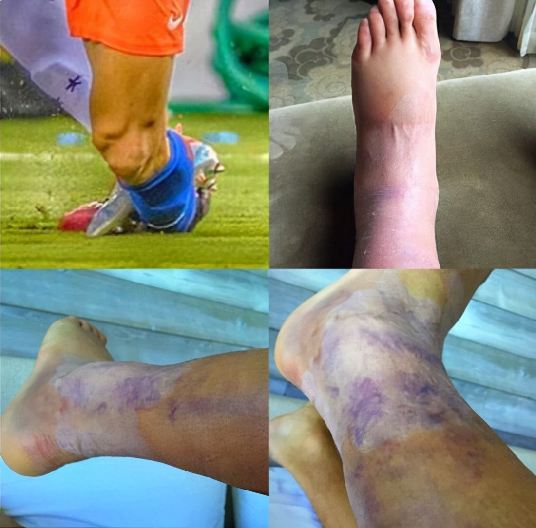 内马尔脚踝90度扭曲无缘世界杯,内马尔脚踝90度受伤