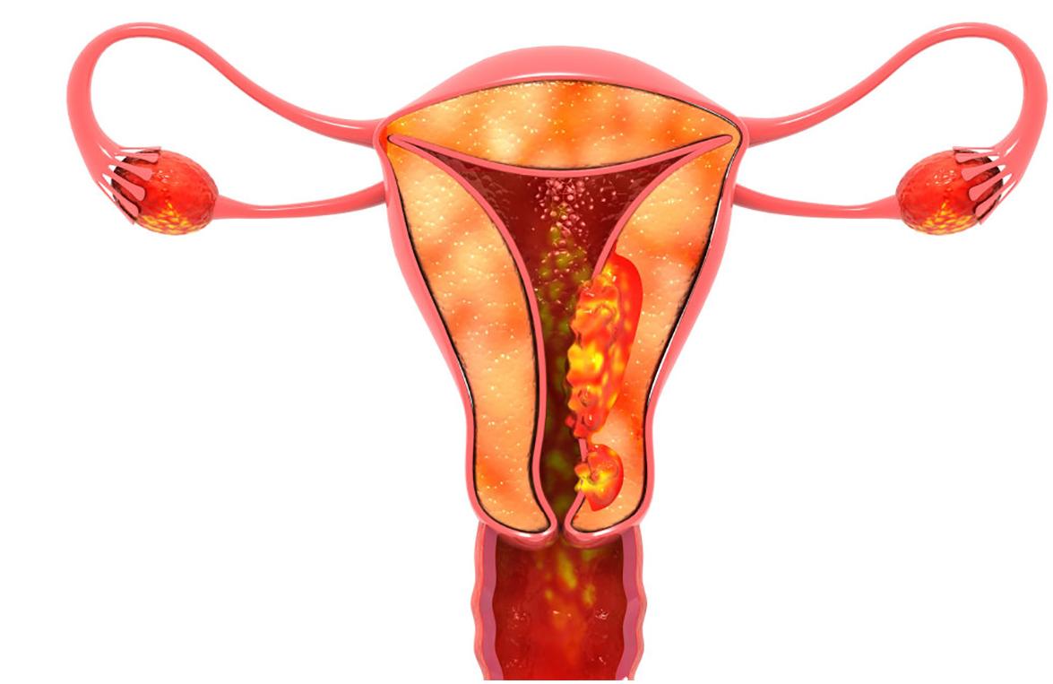 近年来女性宫颈癌高发，宫颈癌与男人的关系大吗？【...