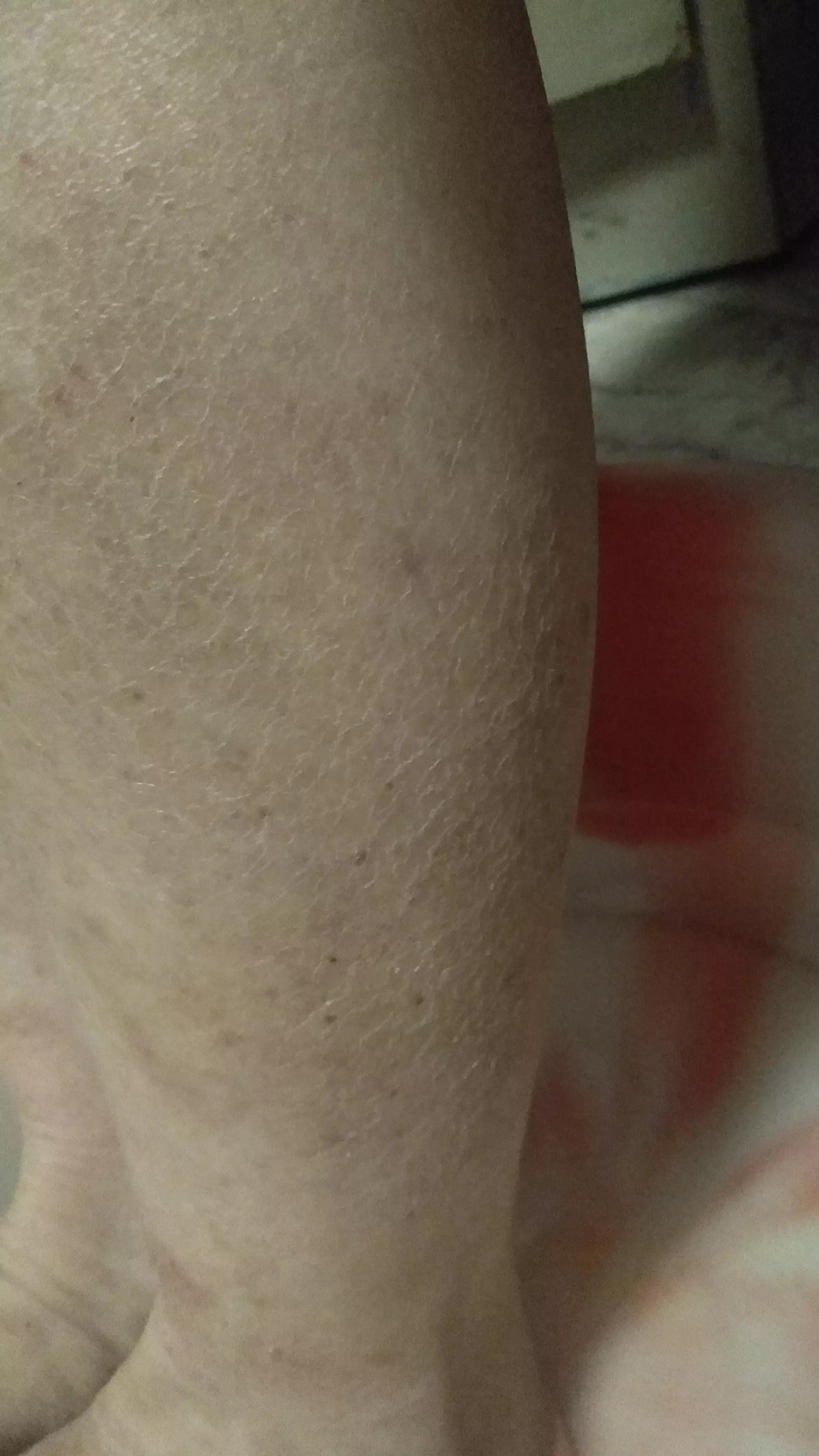 我湿疹复位以后还晕吃什么药,我湿疹怎么是一圈一圈的