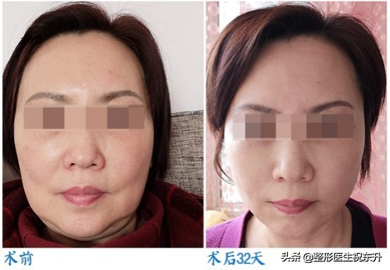 40岁能做小拉皮手术吗,50岁可以做小拉皮手术吗