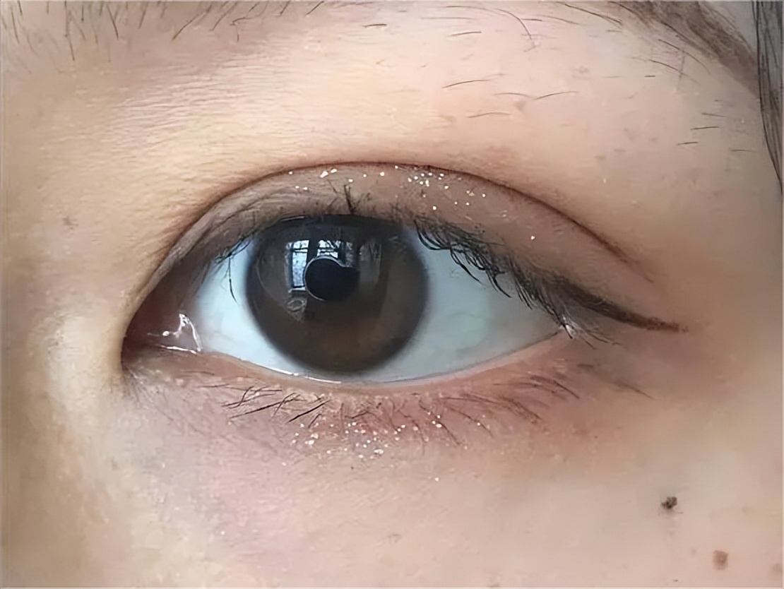 双眼皮术后眼头紧绷有细纹,双眼皮术后很多疤痕怎么办