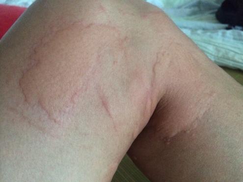 男子携妻小去水上乐园后感染“难言之隐”？夏天还能安全玩水吗？