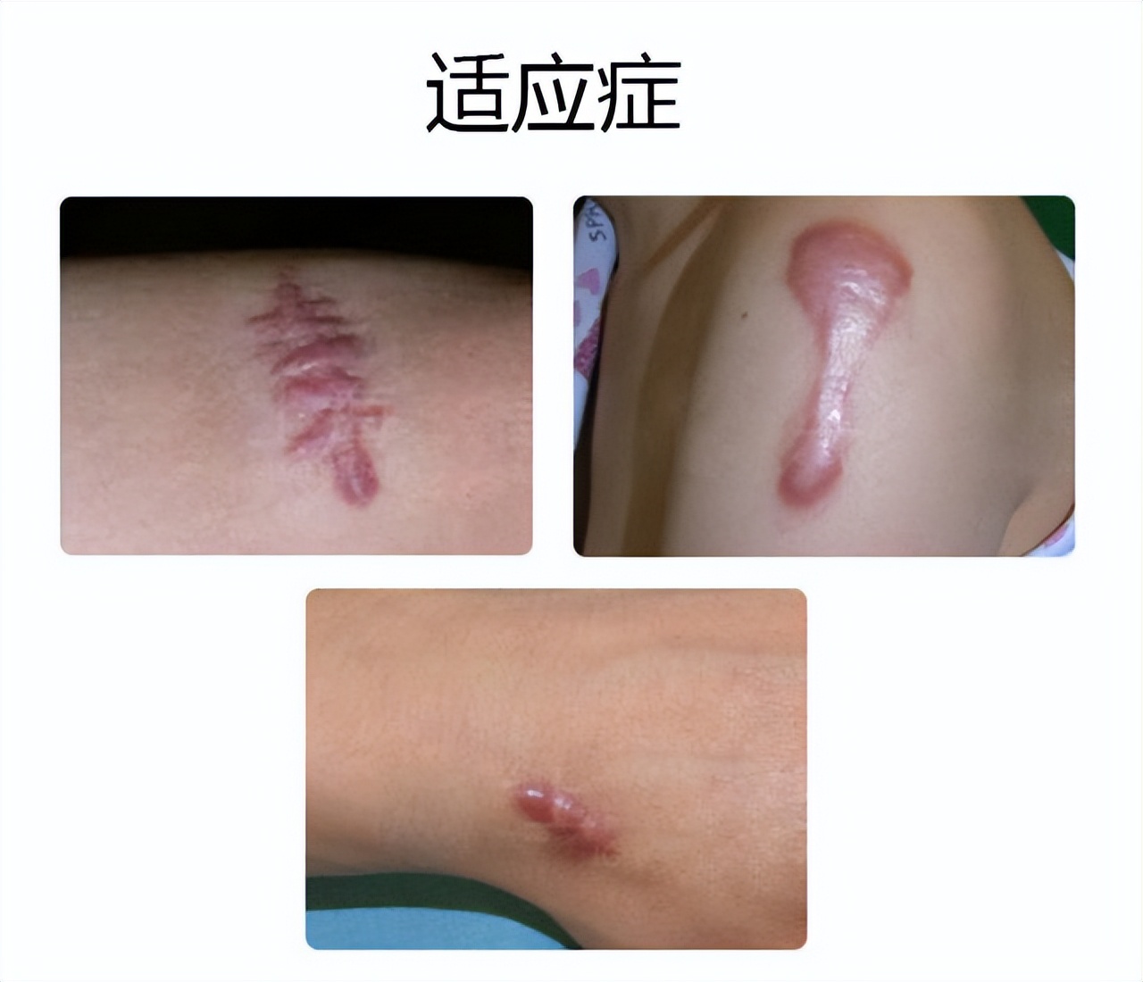 唇裂怎么消除疤痕,唇裂术后怎么预防增生