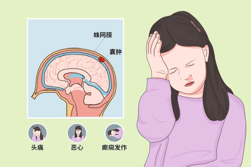 蛛网膜囊肿要不要手术,蛛网膜囊肿怎么才需要手术