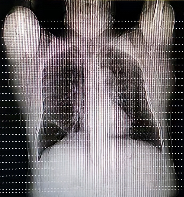 支气管炎早期表现该怎么用药,腹股沟斜疝住院治疗要多长时间