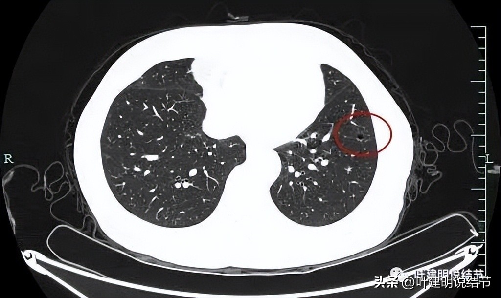 辽宁省肺结节手术哪家医院好,辽宁肺结节手术医院