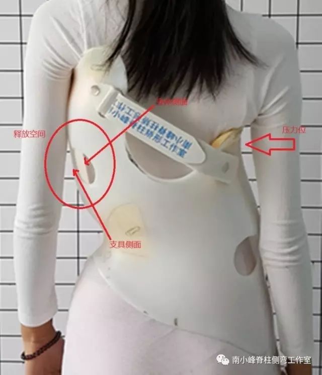 脊柱侧弯矫正支具不调整会怎样,简单辨别脊柱侧弯避免孩子走弯路