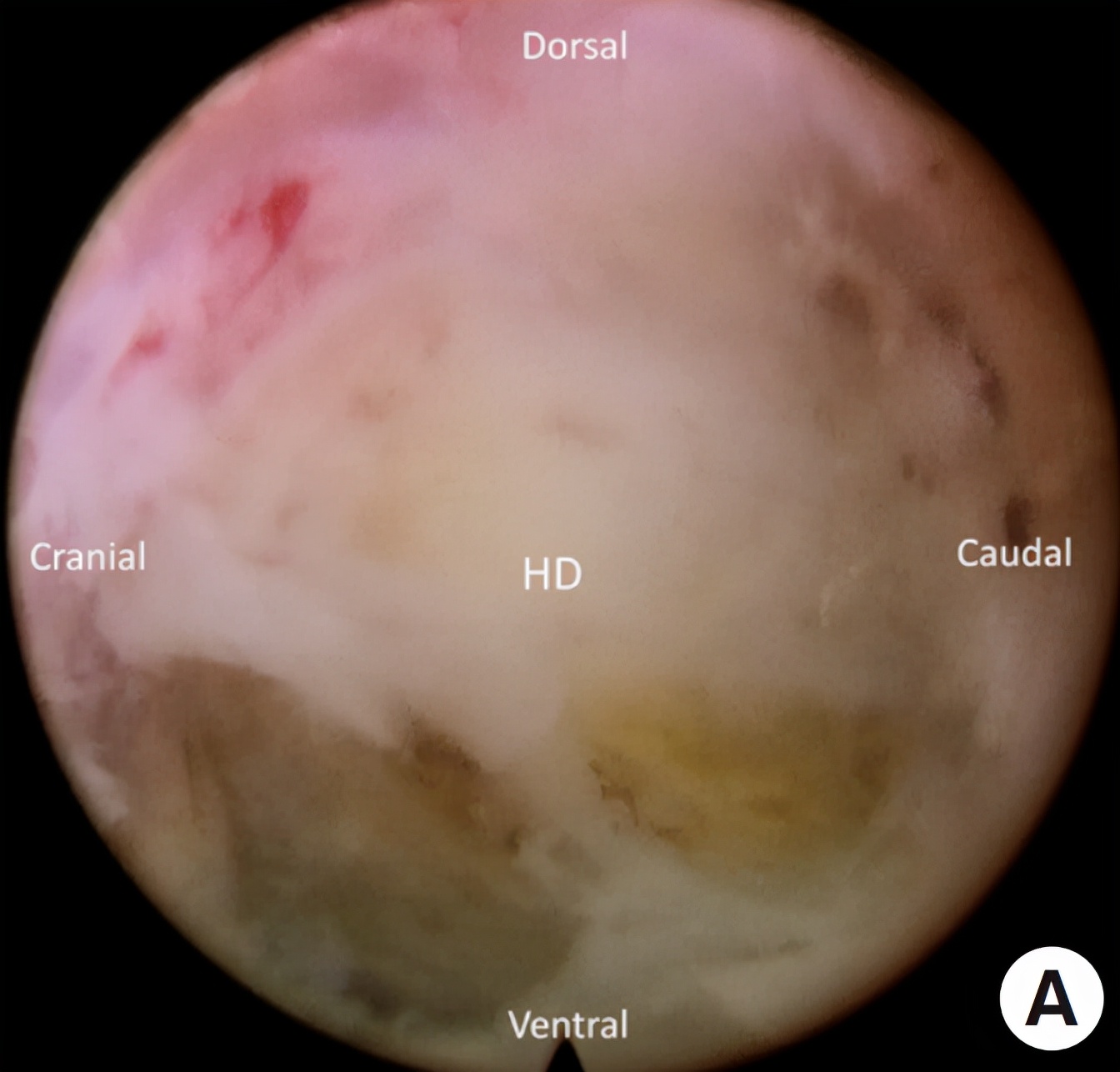 椎间孔镜微创介入治疗椎间盘突出,腰3-4椎间盘突出针刀治疗