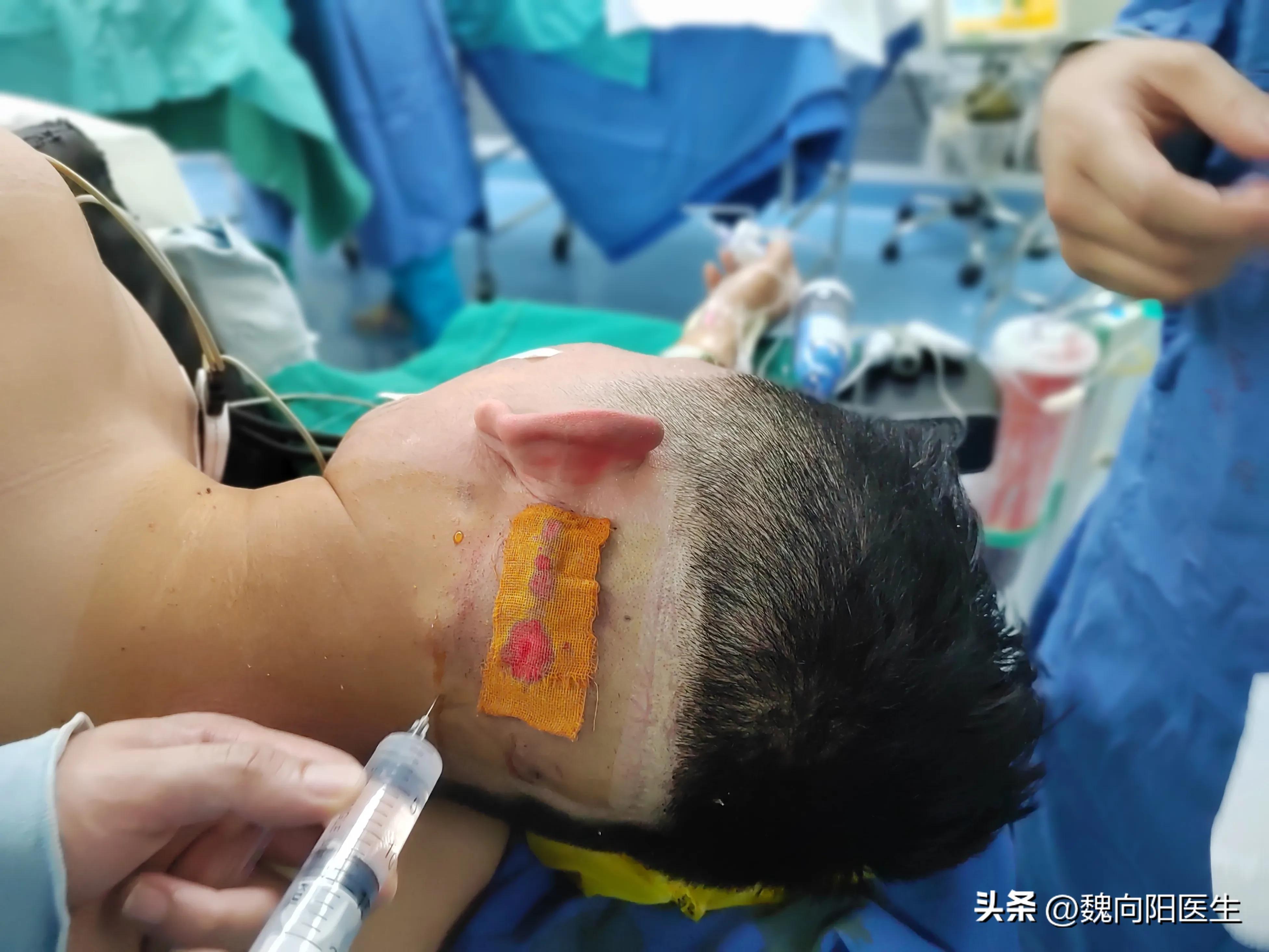 三叉神经痛可以针灸治疗吗,三叉神经痛是什么位置图片