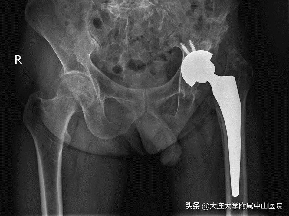 3d打印关节假体,3d打印假体成功案例