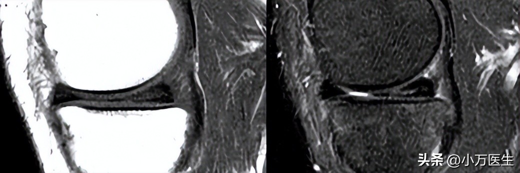 半月板后角撕裂微创手术,半月板撕裂分型
