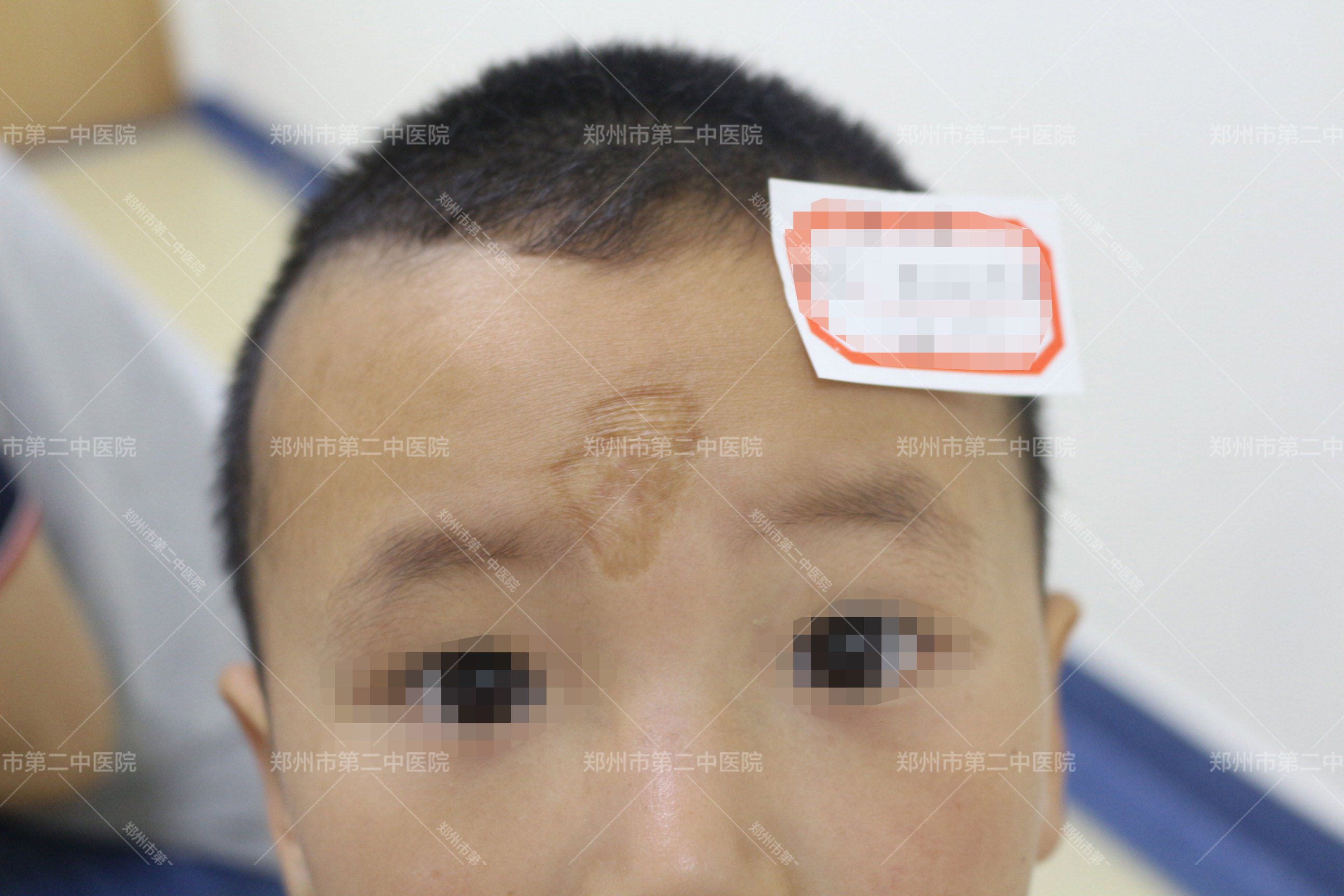 三甲医院疤痕去除,郑州第二中医院怎样祛疤痕