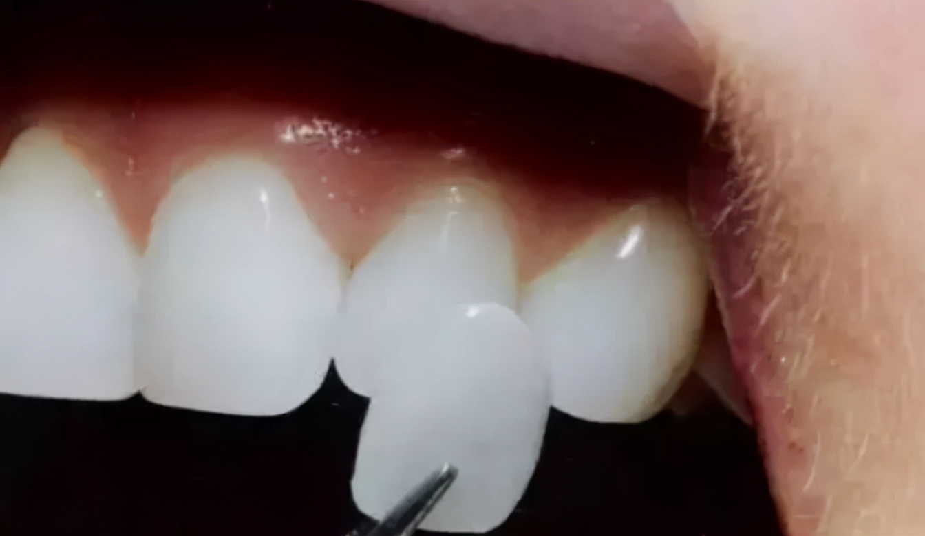 烤瓷牙好不舒服,烤瓷牙好不好看