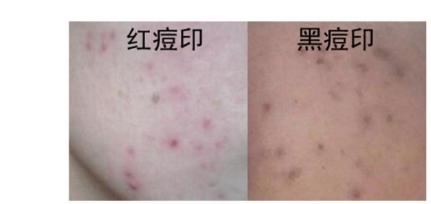 玛恩医生怎么样,玛恩医院祛疤痕靠谱吗