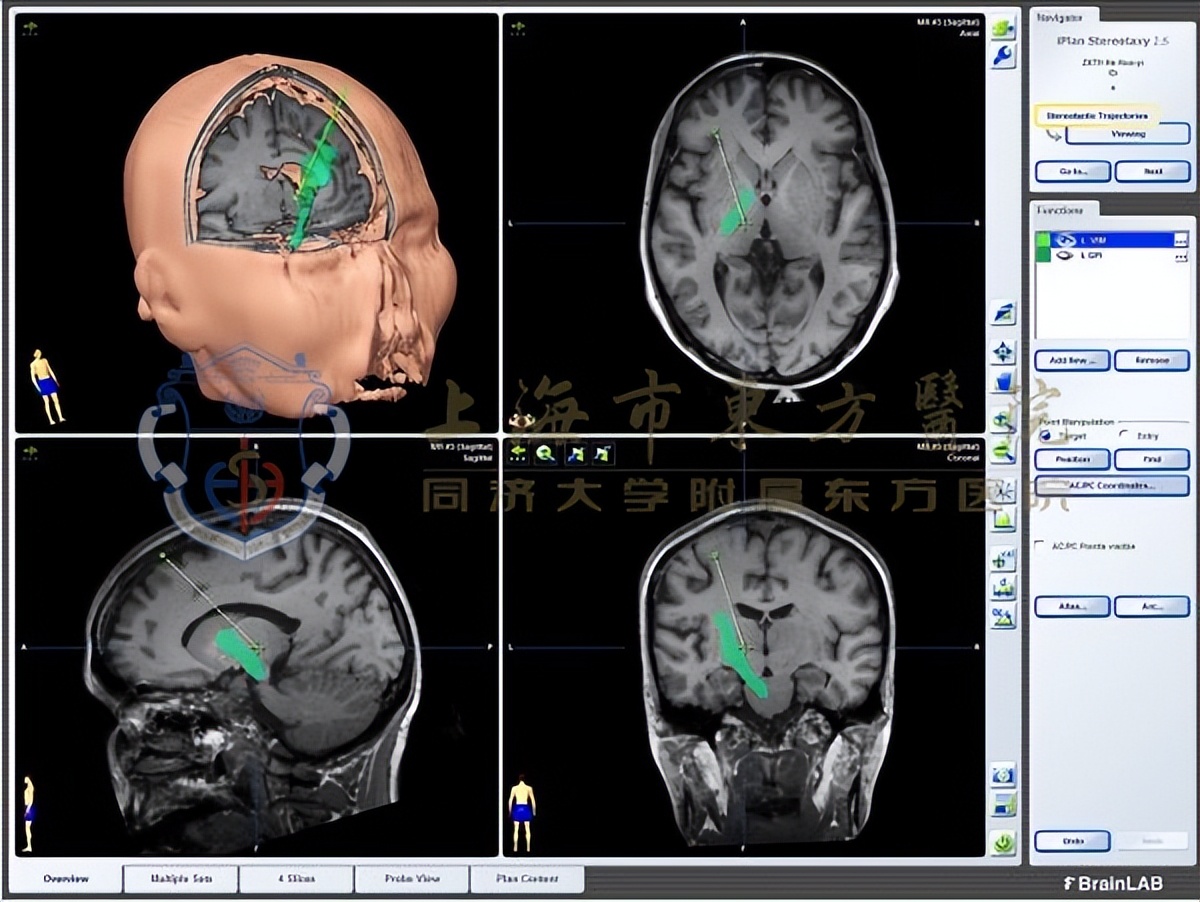 双相情感障碍药物疗效不佳医生教你如何调整治疗方案