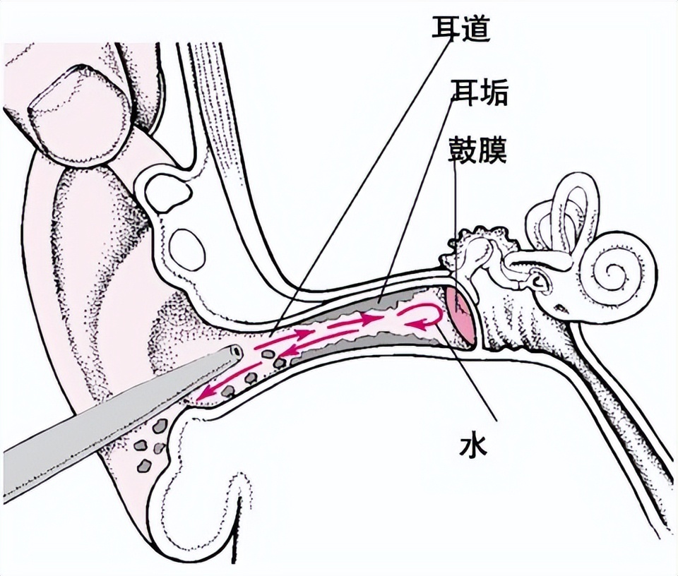 如何根据耳屎判断身体状况,怎么判断耳屎比较多还是少