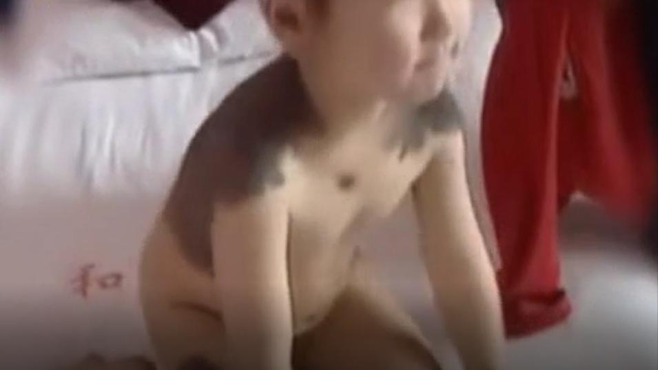 割皮救子父亲康复情况,儿子刚出生为弟弟捐骨髓后续