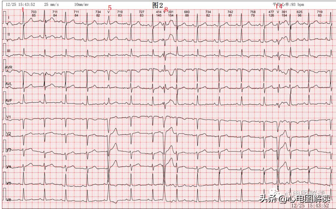 窦性心律偶见室性融合波,室性并行性心律
