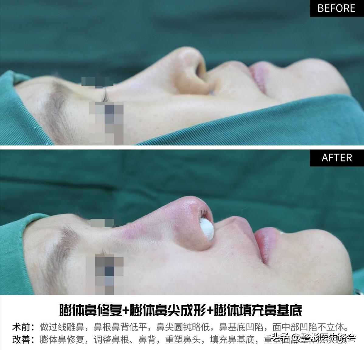 隆鼻三年后可以蹦极嘛,做了隆鼻到底可以蹦极吗