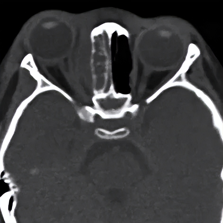 三岁女童被感染,三岁女孩感染病毒