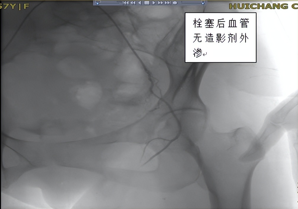 宫颈癌出血介入栓塞止血,江西赣州做宫颈癌手术