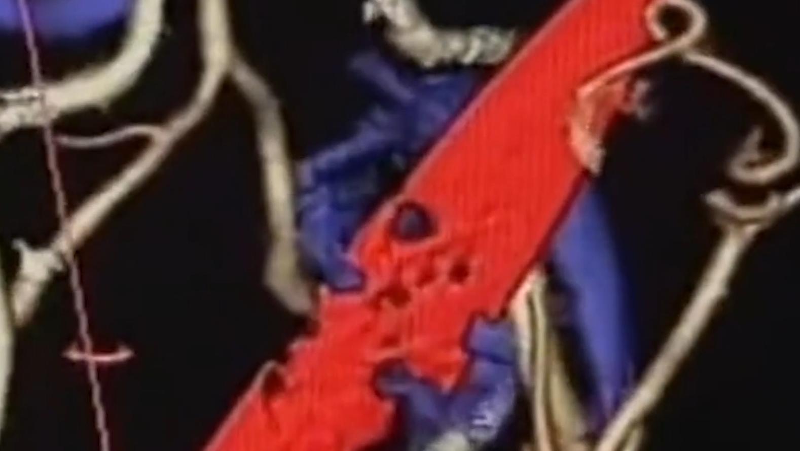 云南男子口臭手术后现在怎么样了,云南男子口臭查出了大毛病