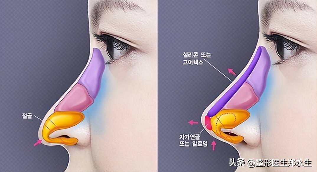 丑鼻子如何变成好看的鼻子,什么样的鼻子让人难看