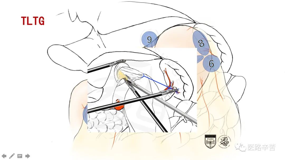 全腹腔镜胃癌根治术，学习大咖怎么清扫淋巴结